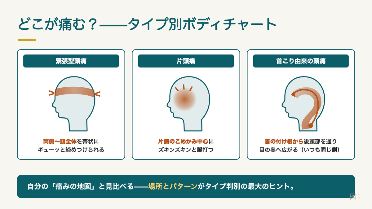 頭痛3タイプのボディチャート。緊張型頭痛は両側から頭全体を帯状に締めつけられる、片頭痛は片側のこめかみ中心にズキンズキンと脈打つ、首こり由来の頭痛は首の付け根から後頭部を通り目の奥へ広がる
